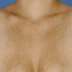 Ciemniejsza skóra na klatce piersiowej choroba amyloidozy skóry 