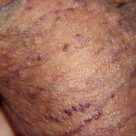 Ciemno czerwone guzki na mosznie rogowiec krwawy