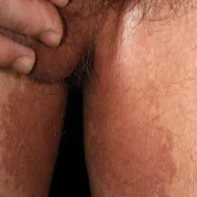 Ciemnobrunatna plama rumieniowa łupież rumieniowy 