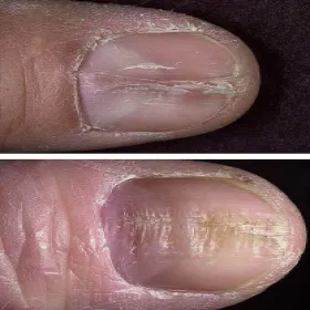 Co to są Linie Beau zdjęcie