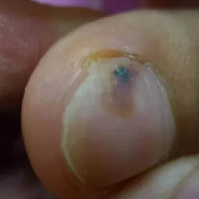 Czarna kropka pod paznokciem