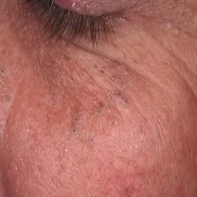 Czarne kropki pod okiem zaskórniki otwarte