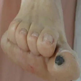 Czerniak dużego palca