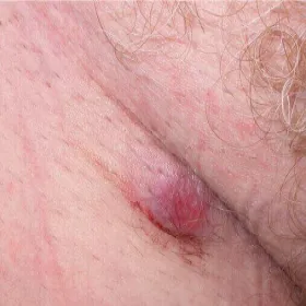 Czerniak miejsc intymnych