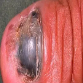 Czerniak na paznokciu