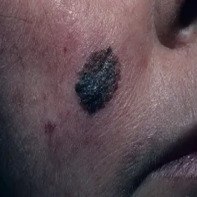Czerniak na skórze polika