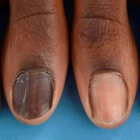 Czerniak podpaznokciowy krwiak pod paznokciem