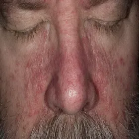 Czerwona łuszcząca skóra na twarzy