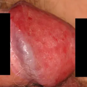 Czerwona główka penisa erytroplazja Queyrata