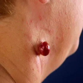 Czerwona narośl na szyi