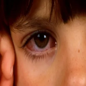 Czerwona spojówka choroba Kawasakiego 