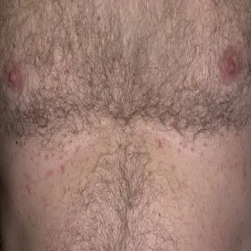 Czerwona wysypka choroba Grovera