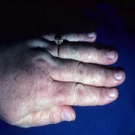 Czerwona wysypka na dłoni choroba Dariera