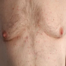 Czerwona wysypka na klatce piersiowej choroba Grovena