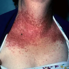 Czerwona wysypka na szyi i dekolcie choorba Dariera