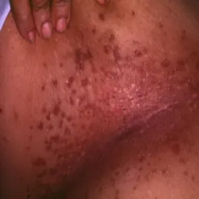 Czerwona wysypka pachwina choroba Dariera