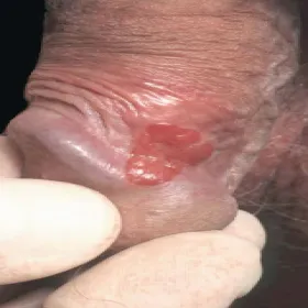 Czerwona zmiana na prąciu erytroplazja Queyrata