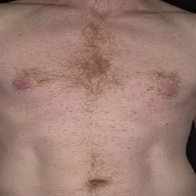 Czerwone kropki na ciele choroba Grovera