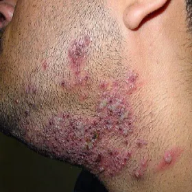 Czerwone krostki na brodzie 