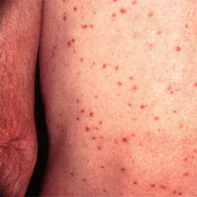 Czerwone krostki na ciele u dorosłych choroba Grovera