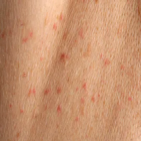 Czerwone krostki na skórze choroba Grovera