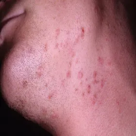 Czerwone krostki na szyi