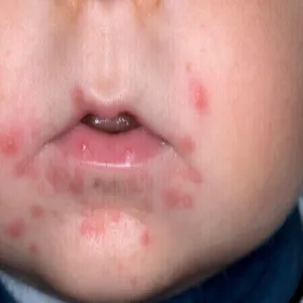 Czerwone krostki wokół ust u dziecka