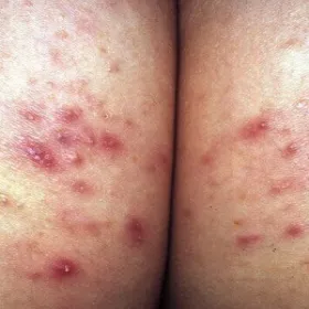 Czerwone krosty na pośladkach zapalenie mieszków włosowych