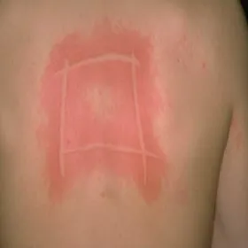 Czerwone linie na skórze