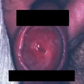 Czerwone plamki na penisie balanitis