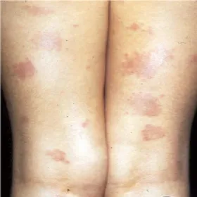 Czerwone plamy na nogach choroba ziarniniak obrączkowaty 