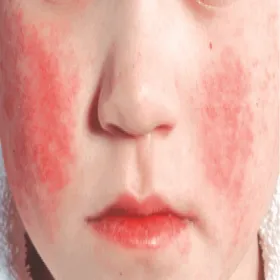 Czerwone plamy na policzkach u dziecka 