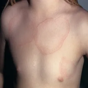 Czerwone plamy na skórze klatki piersiowej ziarniniak obrączkowaty 