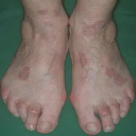 Czerwone plamy na stopach choroba ziarniniak obrączkowaty 