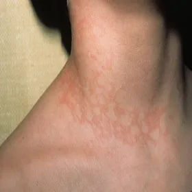 Czerwone plamy na szyi