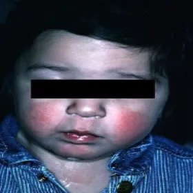 Czerwone policzki choroba rumień