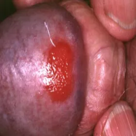 Czerwone prącie zapalenie plazmakomórkowe żołędzi Zoon 