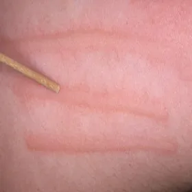 Czerwone pręgi po drapaniu