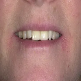 Czerwone suche plamy w kącikach ust