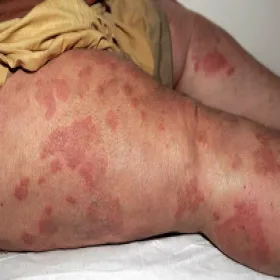 Czerwone swędzące plamy na ciele opryszczkowate zapalenie skóry