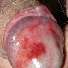 Czerwone swędzące prącie zapalenie żołędzi Zoon 