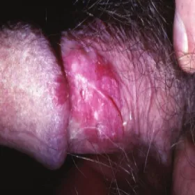 Czerwony napletek erytroplazja Queyrata