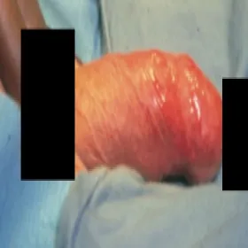 Czerwony napletek i prącie erytroplazja Queyrata