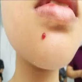 Czerwony miękki guzek na twarzy u dziecka