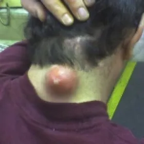 Czyrak duży na szyi