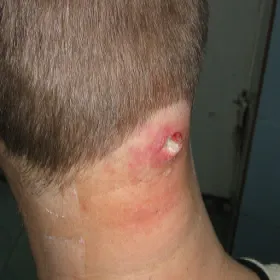 Czyrak u mężczyzny na karku