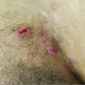 Czyrak w miejscu intymnym zdjęcie