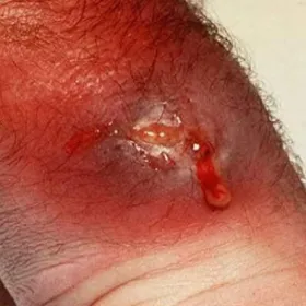 Czyrak z ropą  krwią