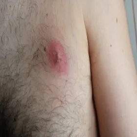 Czyrak na klatce piersiowej u mężczyzny