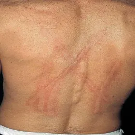 Długo utrzymujące się odciśnięcia na skórze